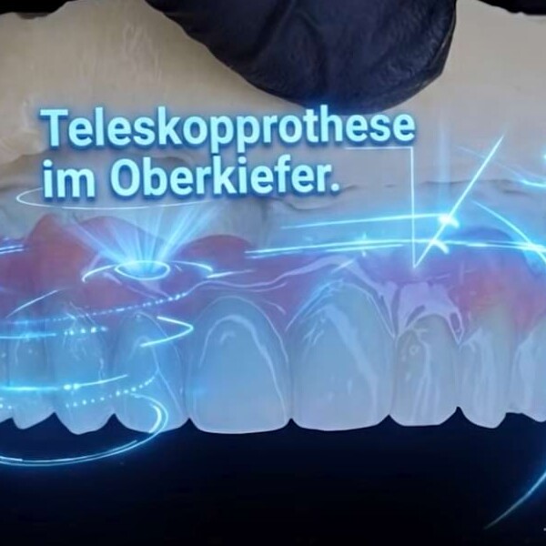 Oberkiefermodell mit Zahnersatz.